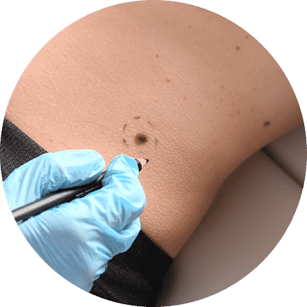 Melanoma — Skin Doctor in Woy Woy, NSW