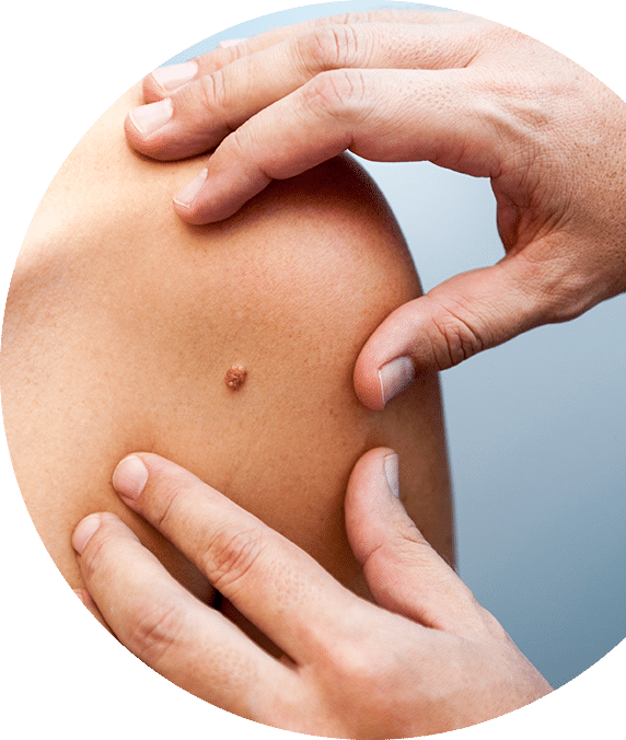 Mole In Patient Skin — Skin Doctor in Woy Woy, NSW